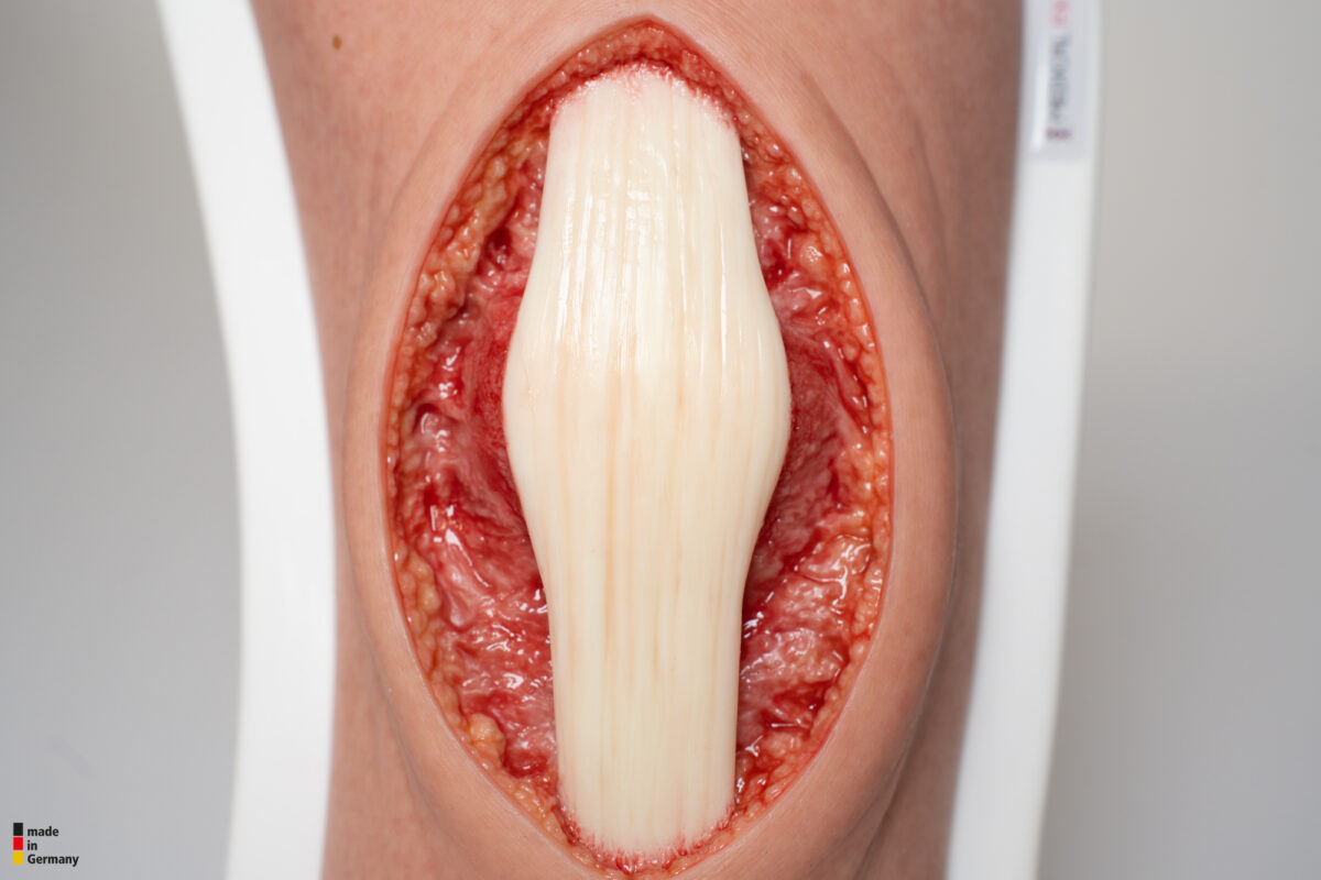Knie mit 2 freiliegenden Sehnen, Patellasehne, Quadrizepssehne