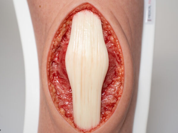 Knie mit 2 freiliegenden Sehnen, Patellasehne, Quadrizepssehne – Bild 2
