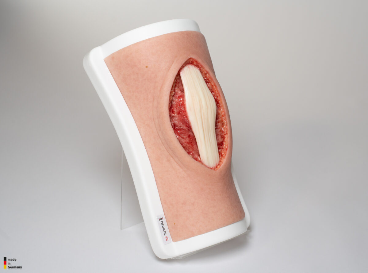 Knie mit 2 freiliegenden Sehnen, Patellasehne, Quadrizepssehne