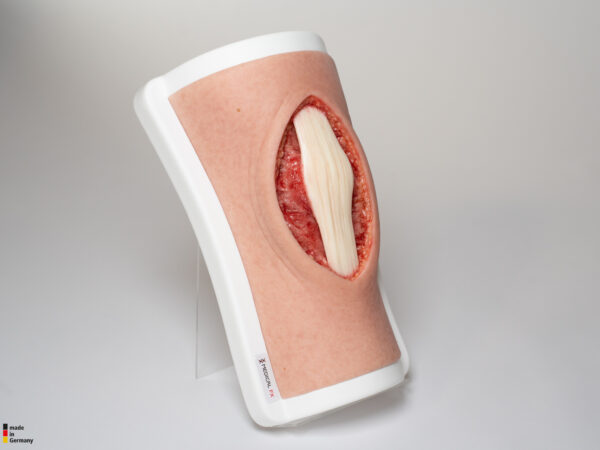 Knie mit 2 freiliegenden Sehnen, Patellasehne, Quadrizepssehne – Bild 4