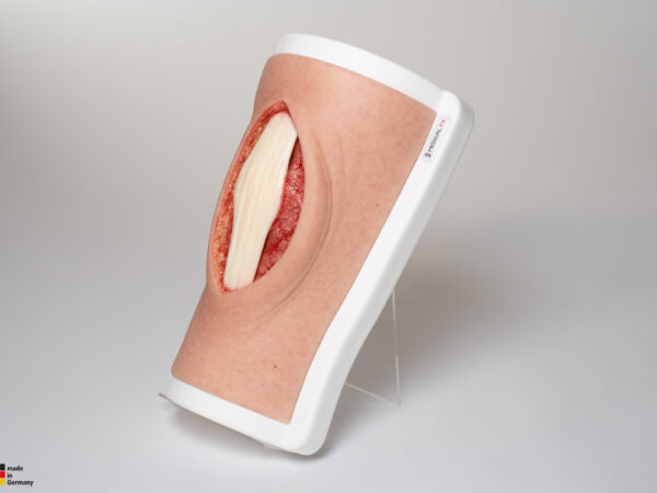 Knie mit 2 freiliegenden Sehnen, Patellasehne, Quadrizepssehne – Bild 3