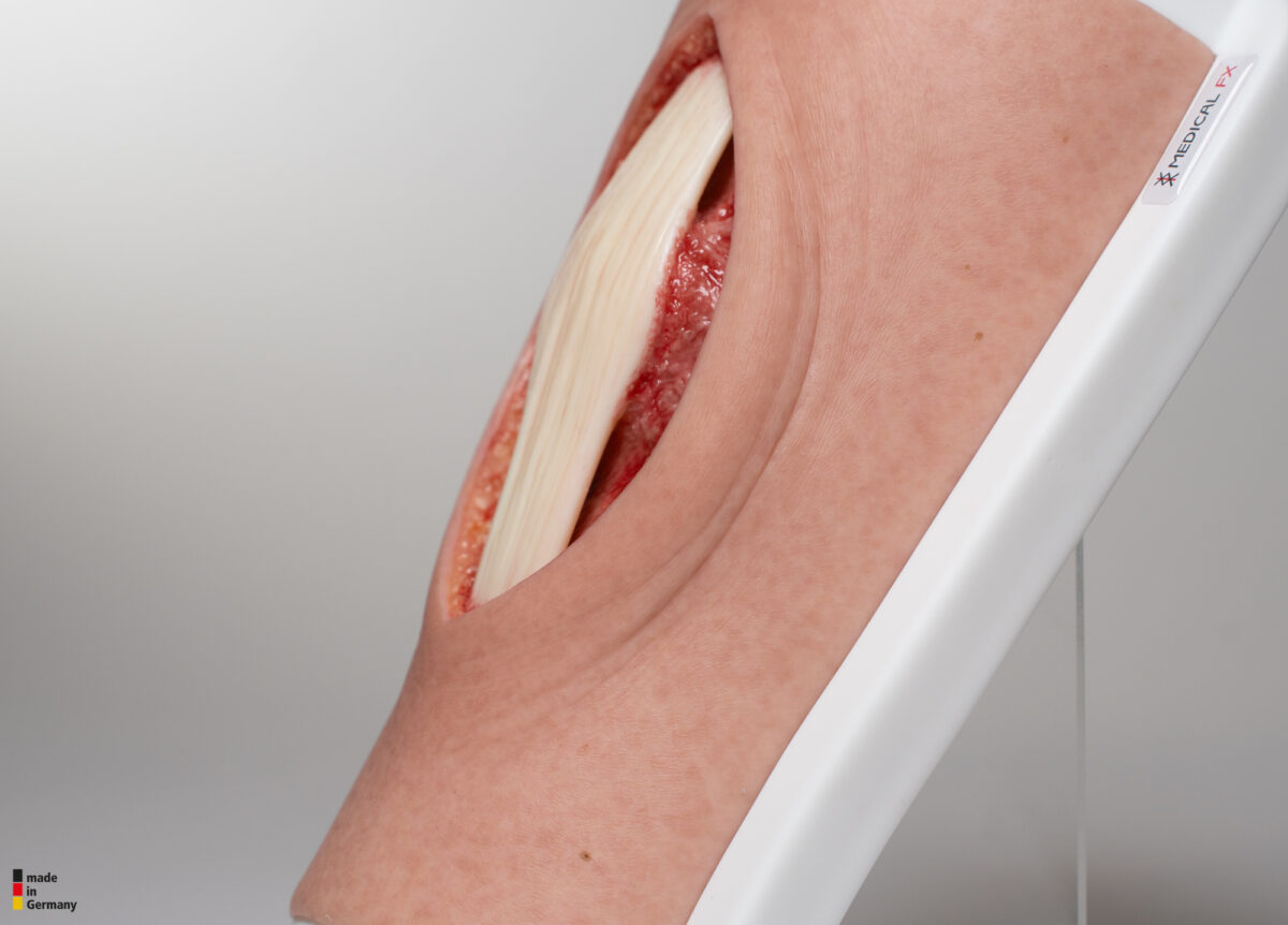 Knie mit 2 freiliegenden Sehnen, Patellasehne, Quadrizepssehne