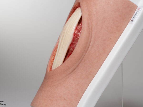 Knie mit 2 freiliegenden Sehnen, Patellasehne, Quadrizepssehne – Bild 6