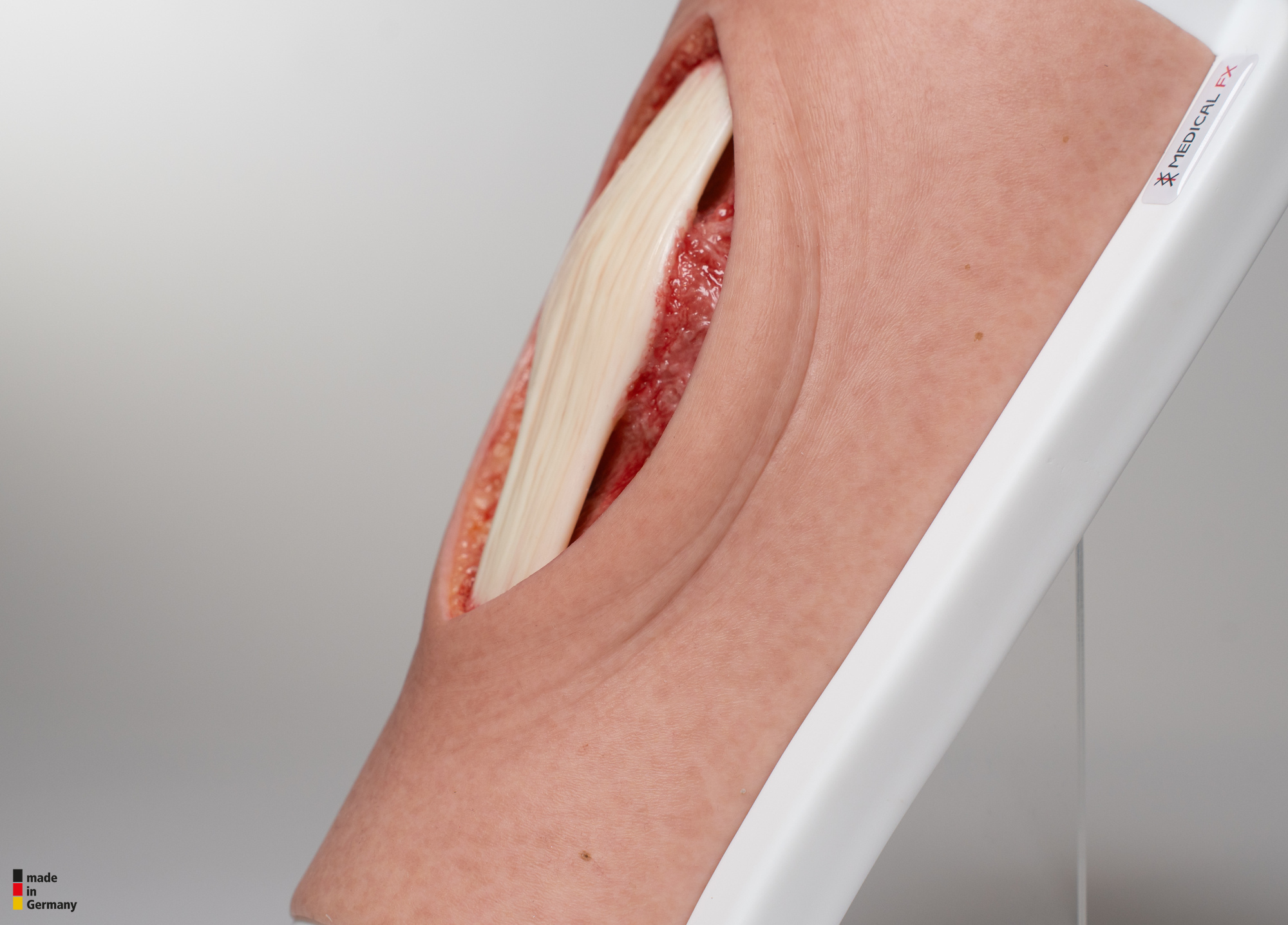 Knie mit 2 freiliegenden Sehnen, Patellasehne, Quadrizepssehne – Bild 6