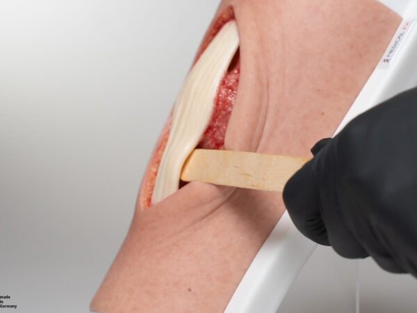 Knie mit 2 freiliegenden Sehnen, Patellasehne, Quadrizepssehne – Bild 7