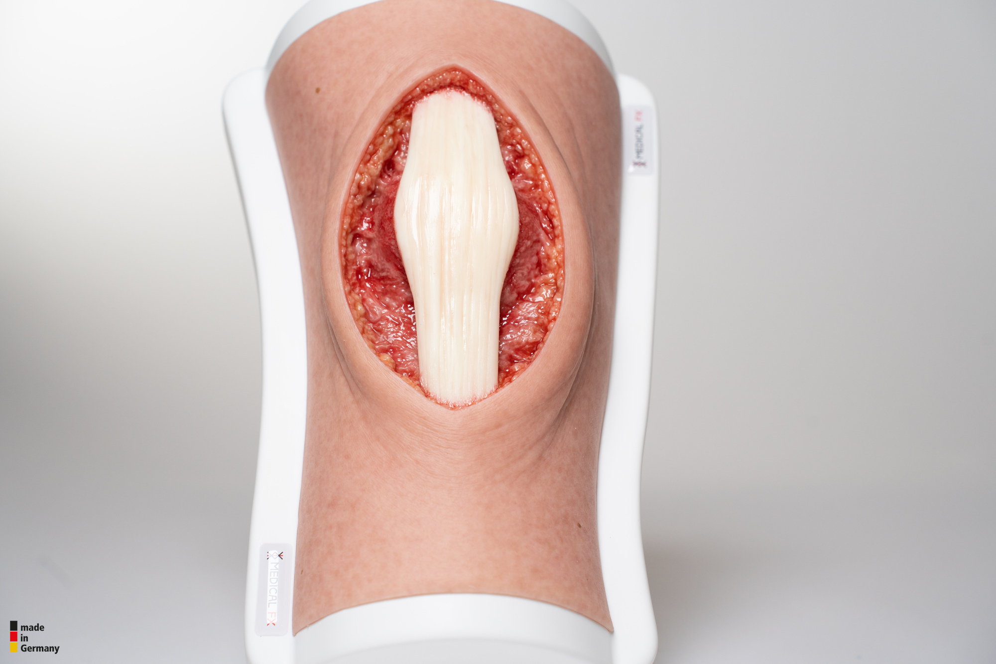 Knie mit 2 freiliegenden Sehnen, Patellasehne, Quadrizepssehne – Bild 8