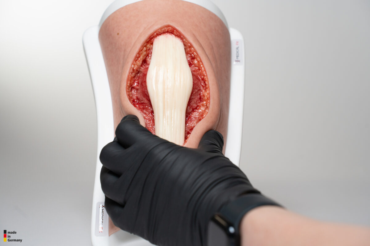 Knie mit 2 freiliegenden Sehnen, Patellasehne, Quadrizepssehne