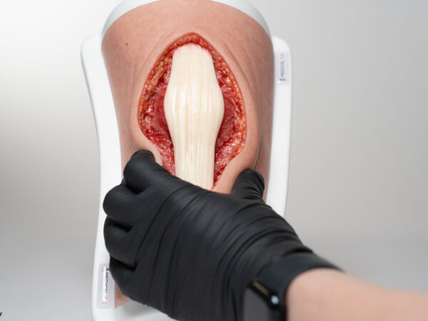 Knie mit 2 freiliegenden Sehnen, Patellasehne, Quadrizepssehne – Bild 9