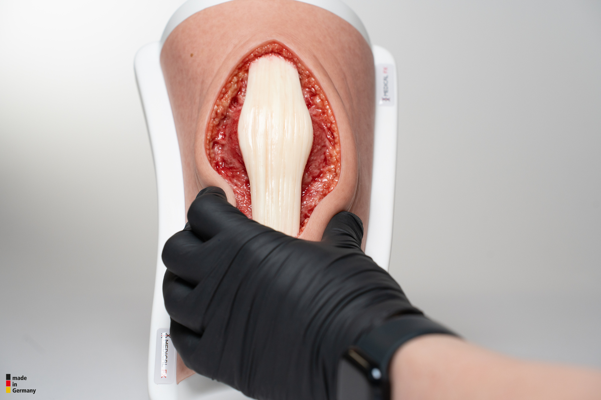 Knie mit 2 freiliegenden Sehnen, Patellasehne, Quadrizepssehne – Bild 9