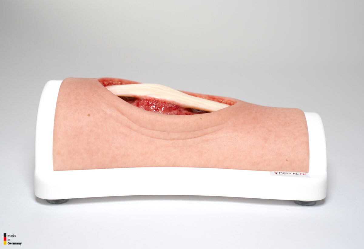 Knie mit 2 freiliegenden Sehnen, Patellasehne, Quadrizepssehne