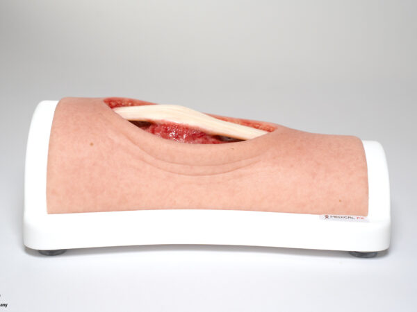 Knie mit 2 freiliegenden Sehnen, Patellasehne, Quadrizepssehne – Bild 5