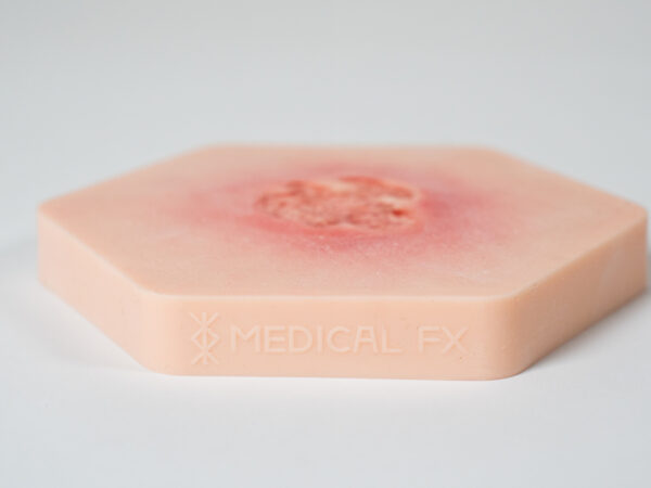 Hexapad Dekubitus Grad 2 flach – Bild 6