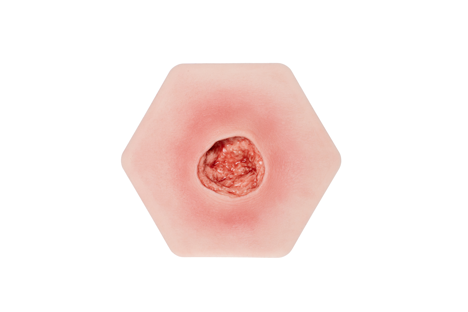 Hexapad Dekubitus Grad 4 tief – Bild 1