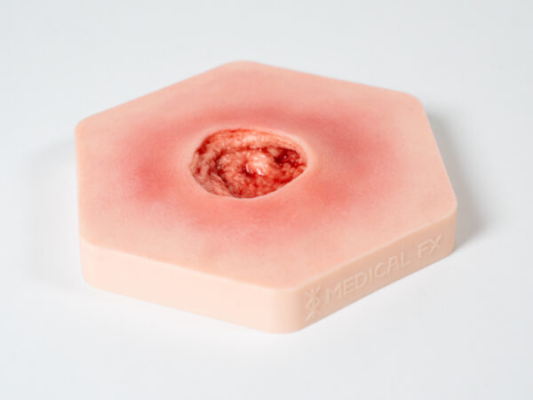 Hexapad Dekubitus Grad 4 tief – Bild 6