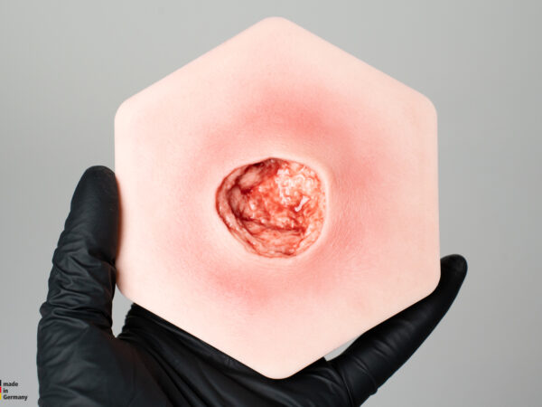 Hexapad Dekubitus Grad 4 tief – Bild 7