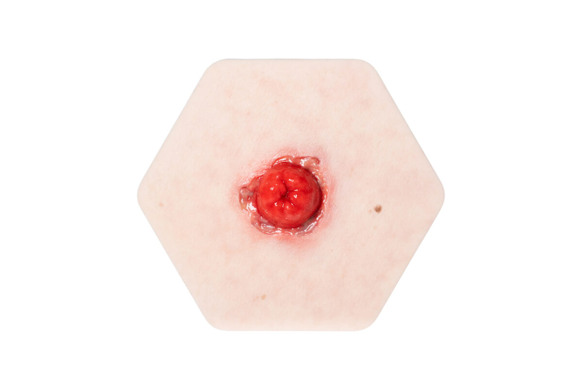 Hexapad Stoma mit Dehiszenz