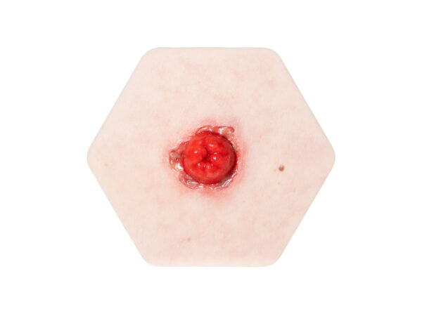 Hexapad Stoma mit Dehiszenz