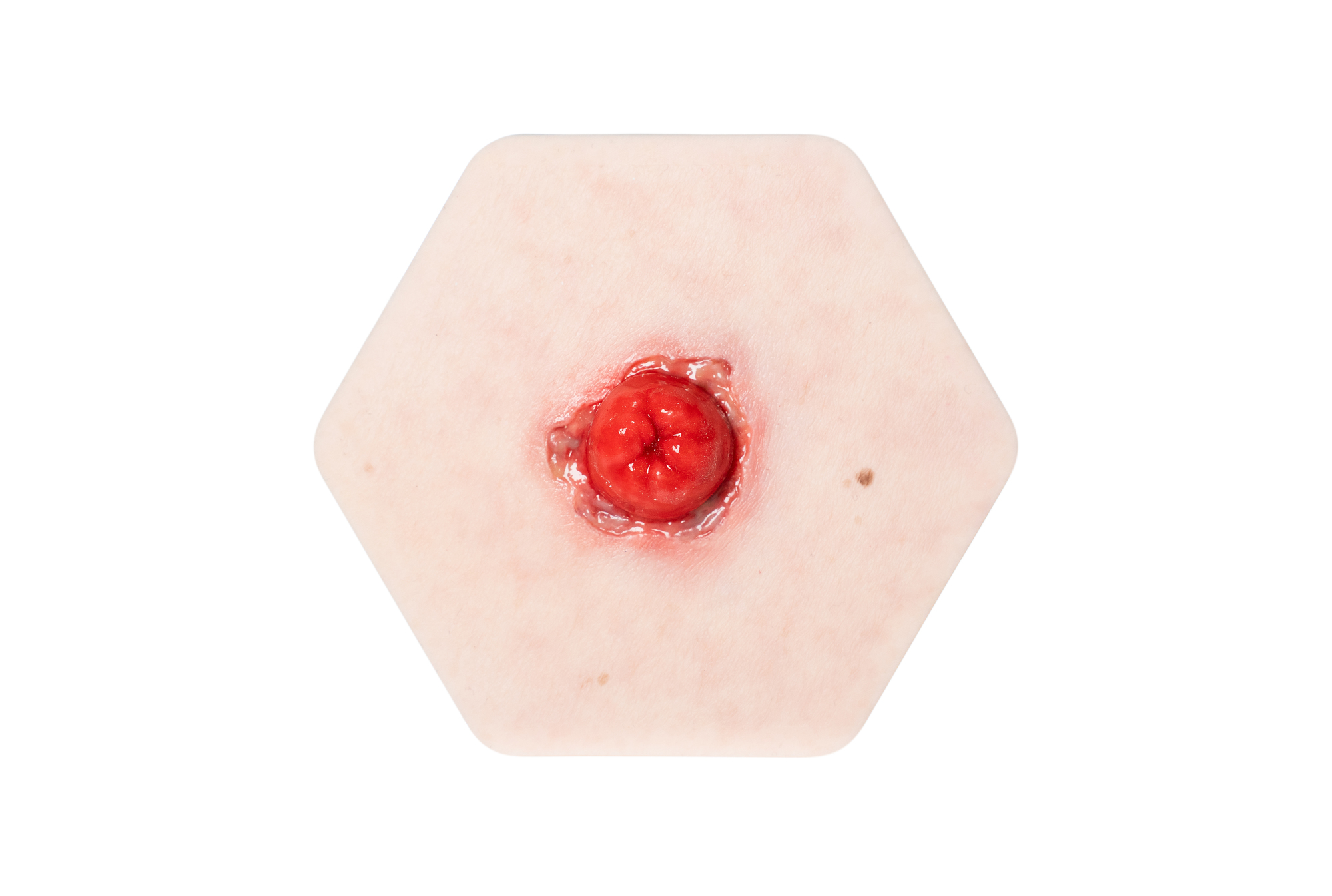 Hexapad Stoma mit Dehiszenz – Bild 1