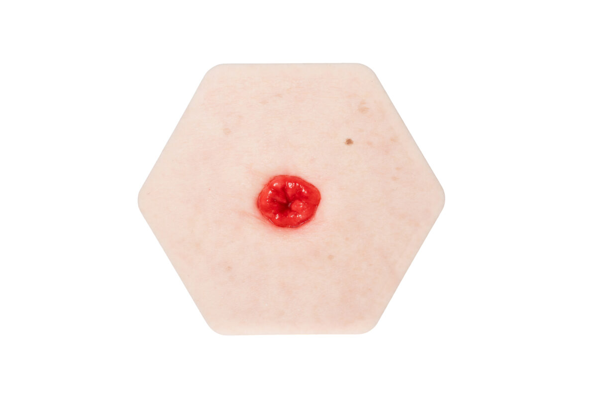 Hexapad Stoma in einer Mulde