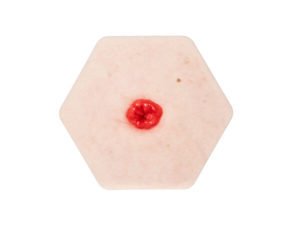 Hexapad Stoma in einer Mulde