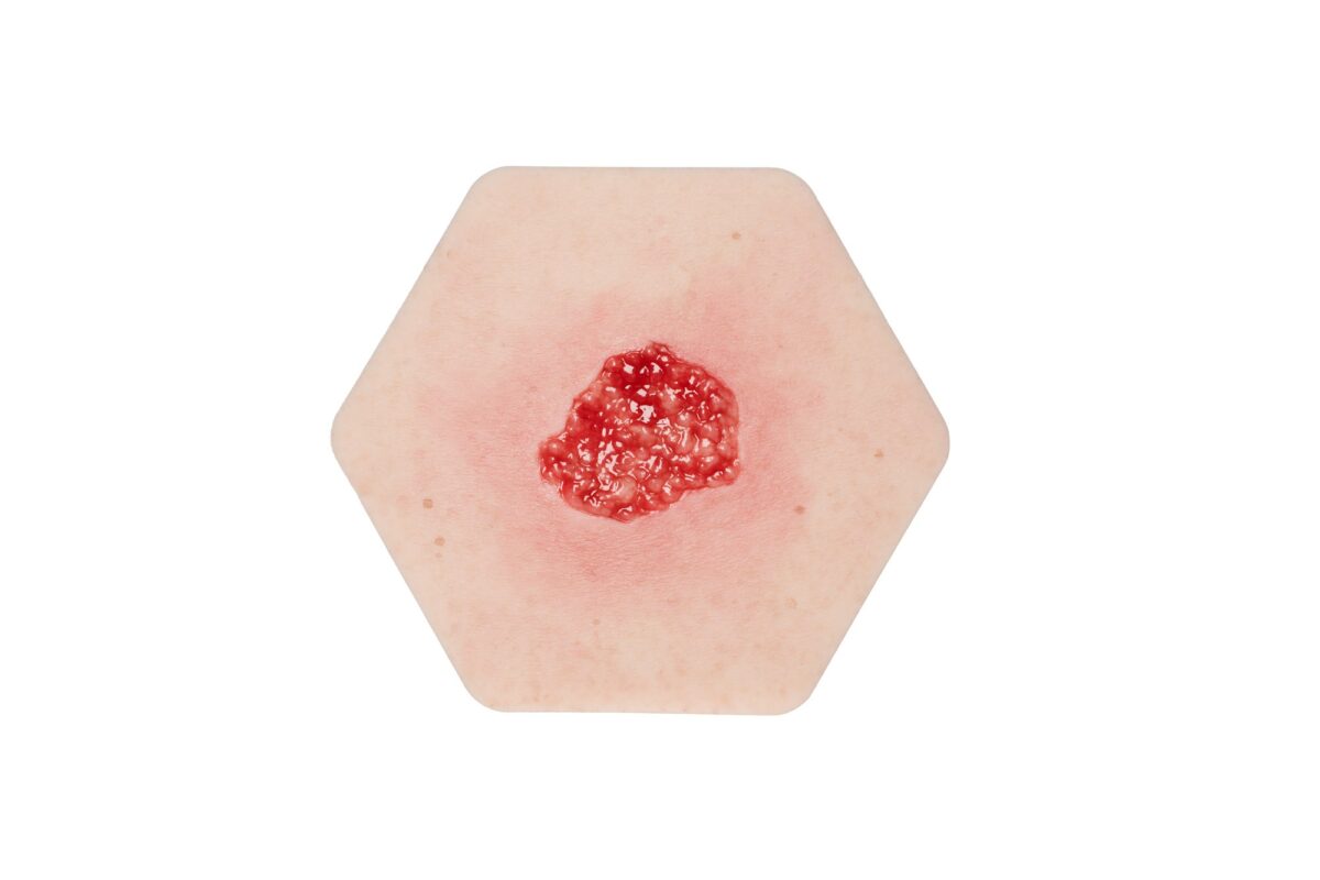 Hypergranulation
