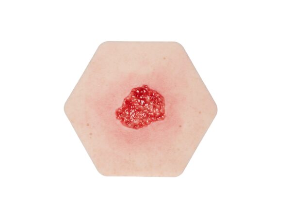 Hypergranulation