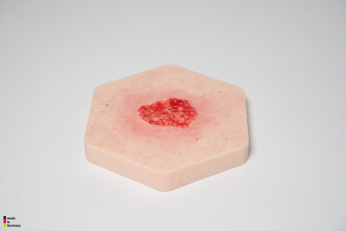 Hexapad Hypergranulation