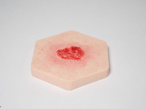 Hexapad Hypergranulation