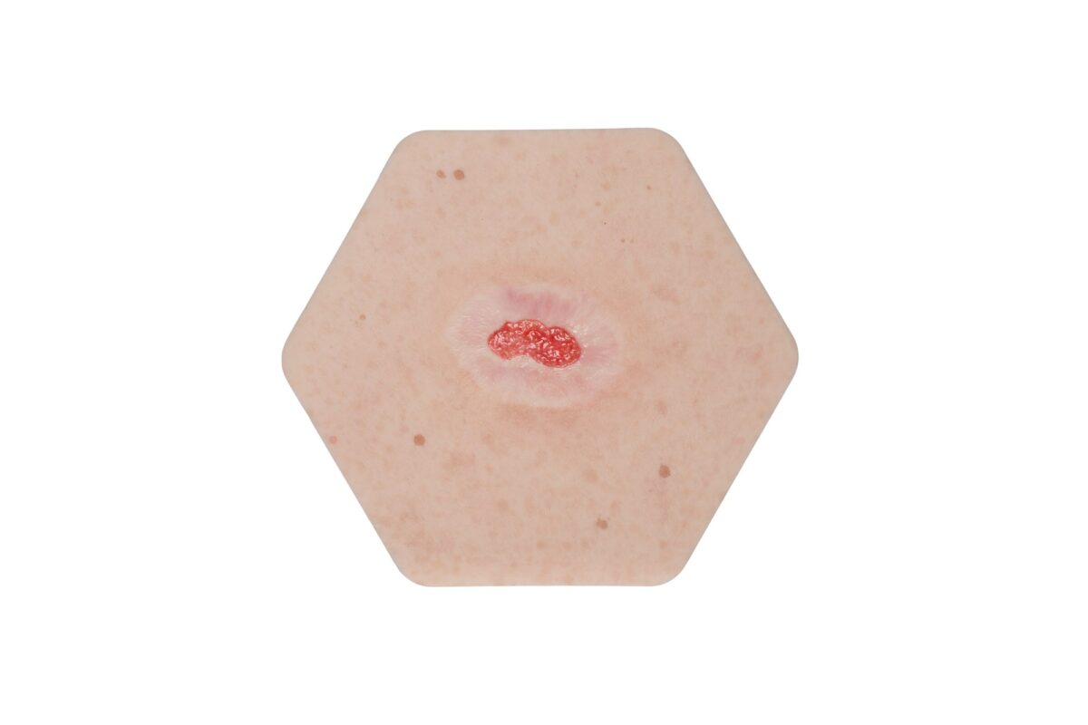 Hexapad Epithelisierung