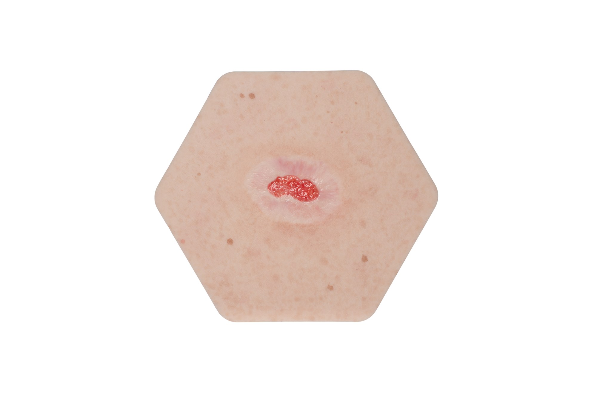 Hexapad Epithelisierung – Bild 1