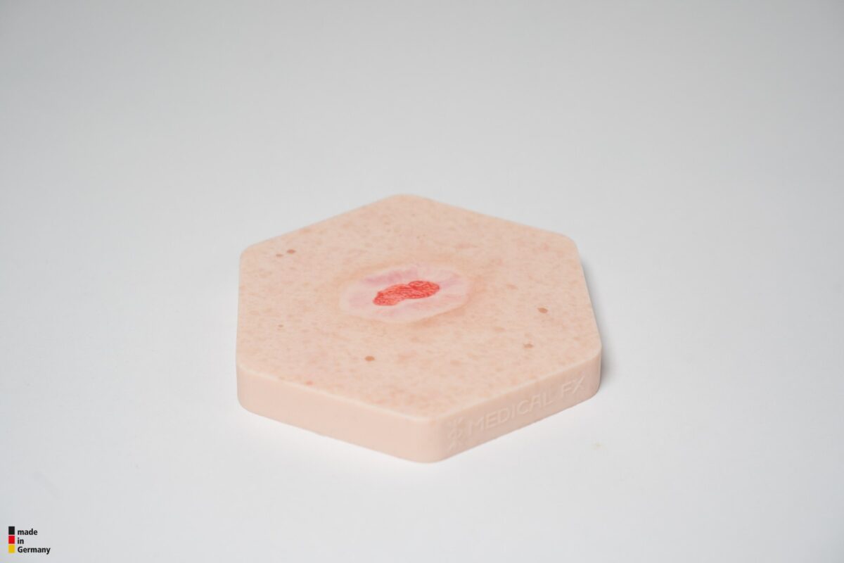 Hexapad Epithelisierung