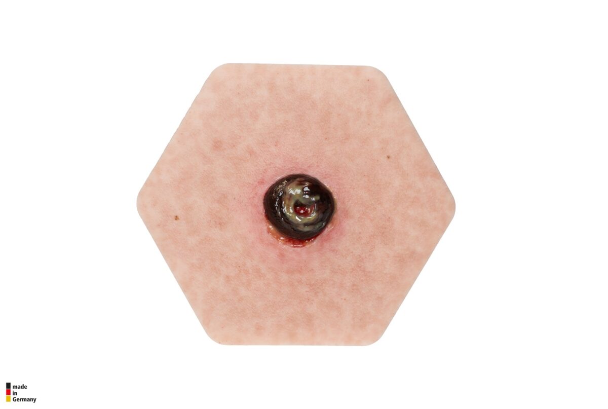 Hexapad Stoma with Necrosis