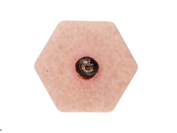 Hexapad Stoma with Necrosis
