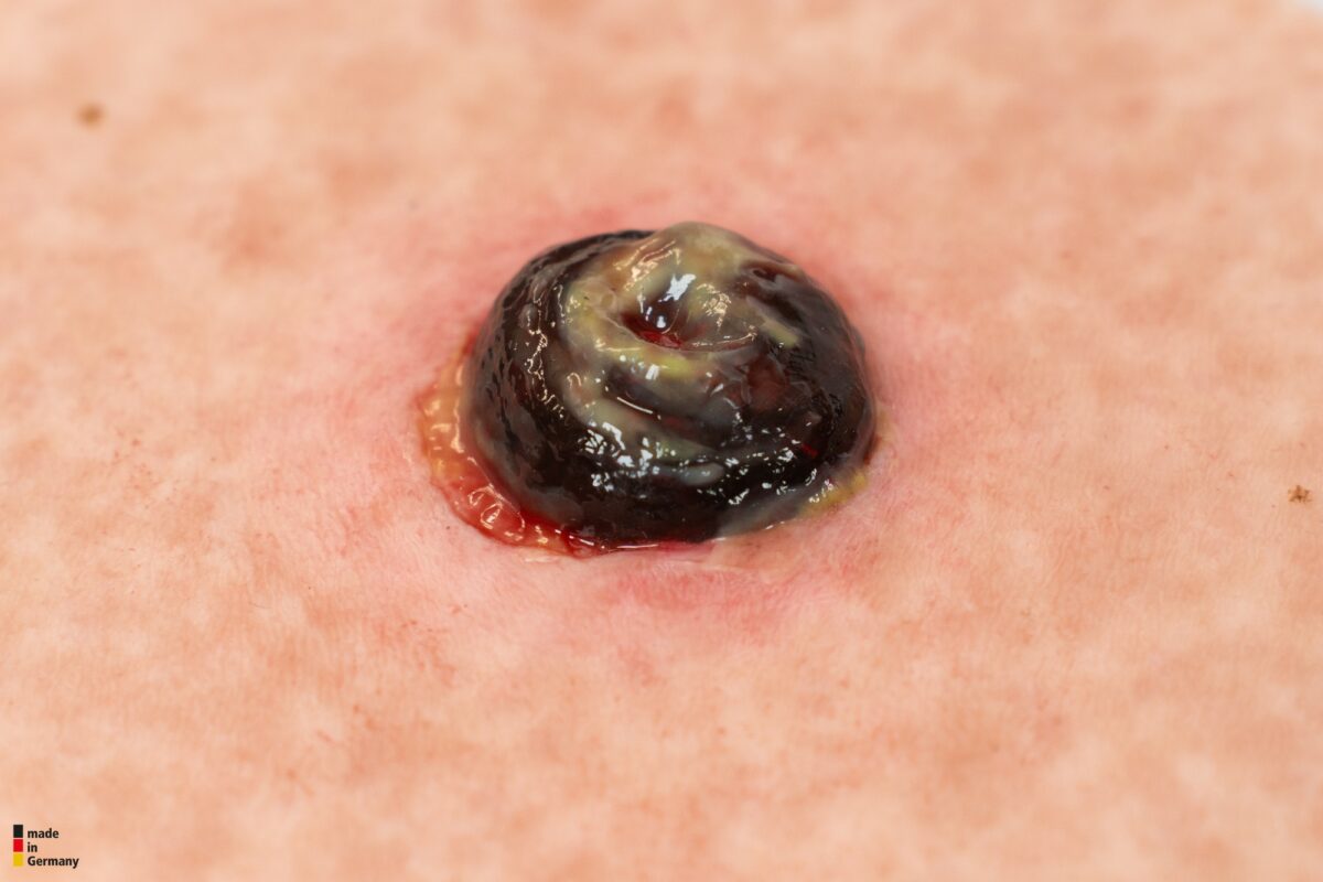 Hexapad Stoma with Necrosis