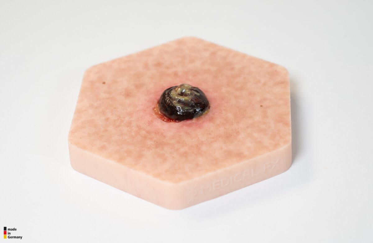 Hexapad Stoma with Necrosis