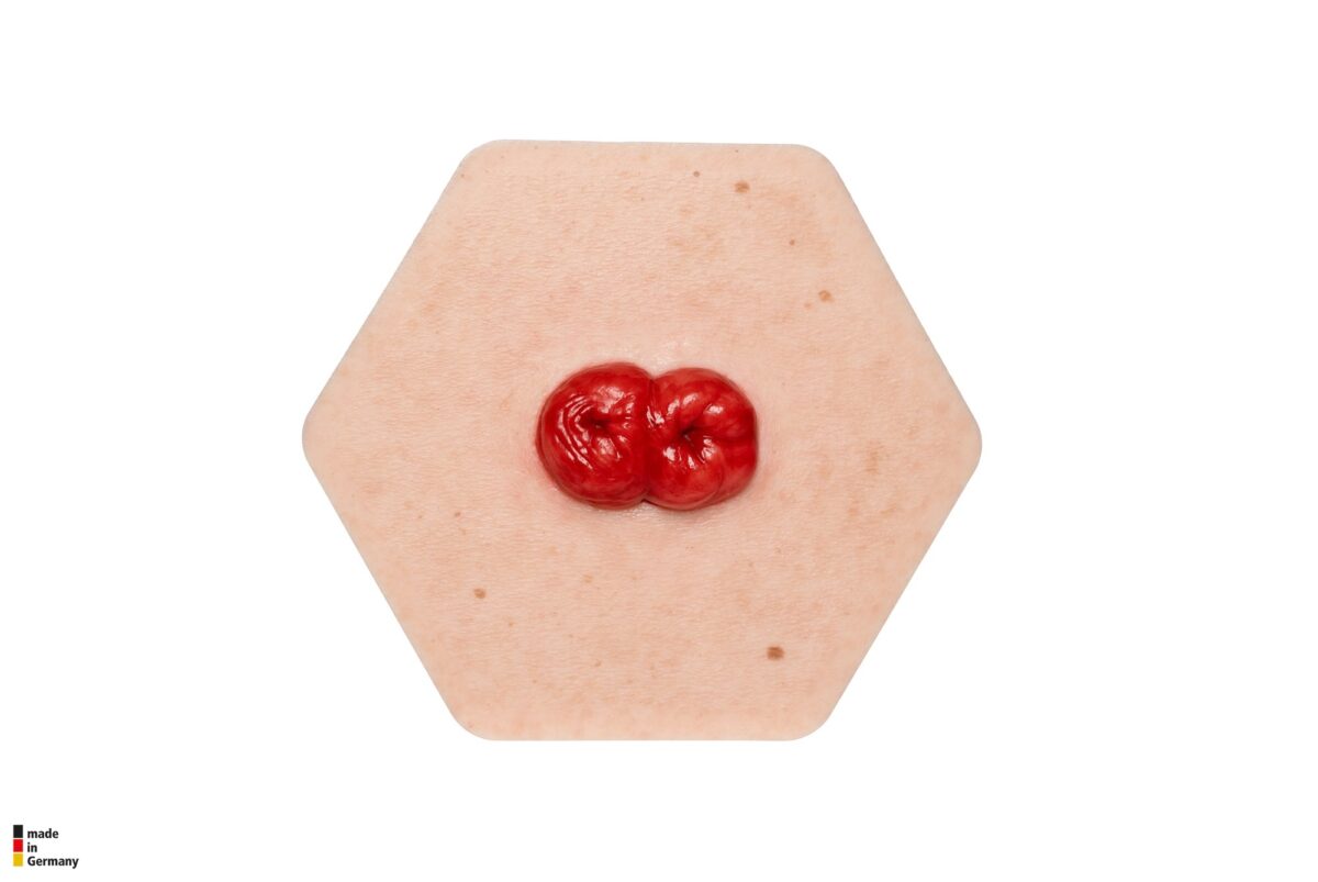 Hexapad Doppelstoma, Doppelläufiges Stoma