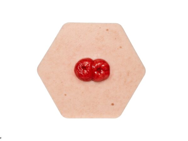 Hexapad Doppelstoma, Doppelläufiges Stoma