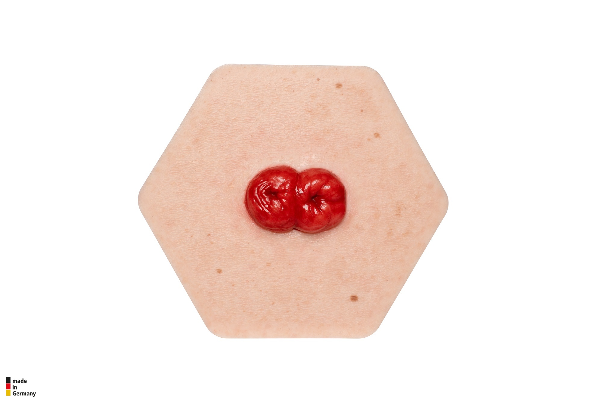 Hexapad Doppelstoma, Doppelläufiges Stoma – Bild 1