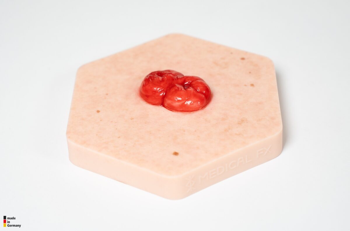 Hexapad Doppelstoma, Doppelläufiges Stoma