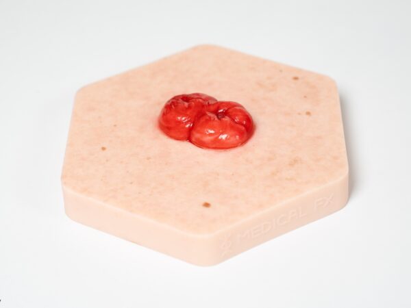 Hexapad Doppelstoma, Doppelläufiges Stoma – Bild 3
