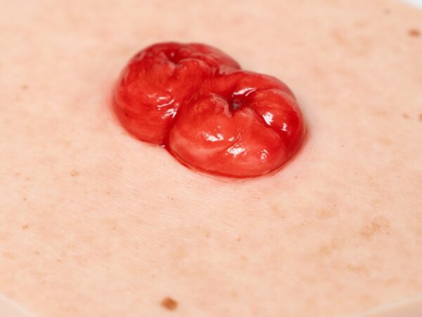 Hexapad Doppelstoma, Doppelläufiges Stoma – Bild 2