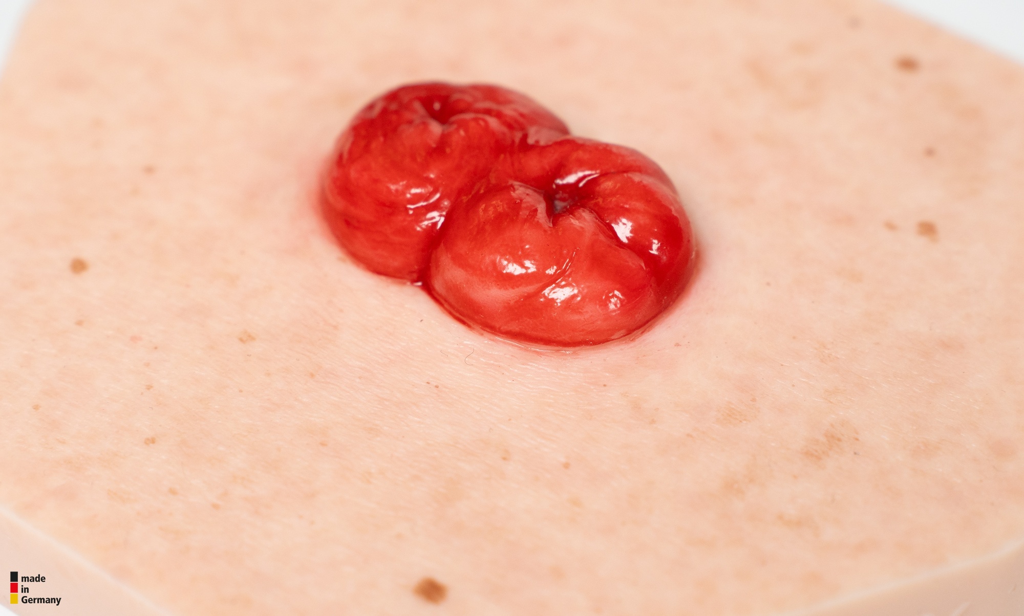 Hexapad Doppelstoma, Doppelläufiges Stoma – Bild 2
