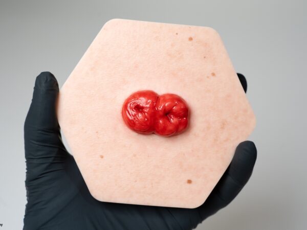 Hexapad Doppelstoma, Doppelläufiges Stoma – Bild 4