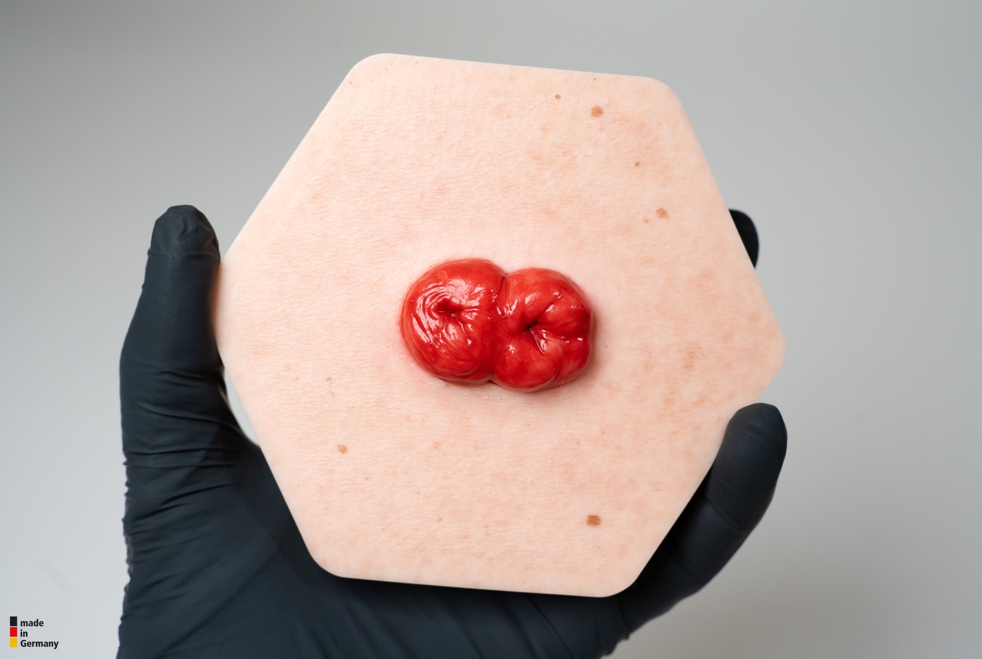 Hexapad Doppelstoma, Doppelläufiges Stoma – Bild 4