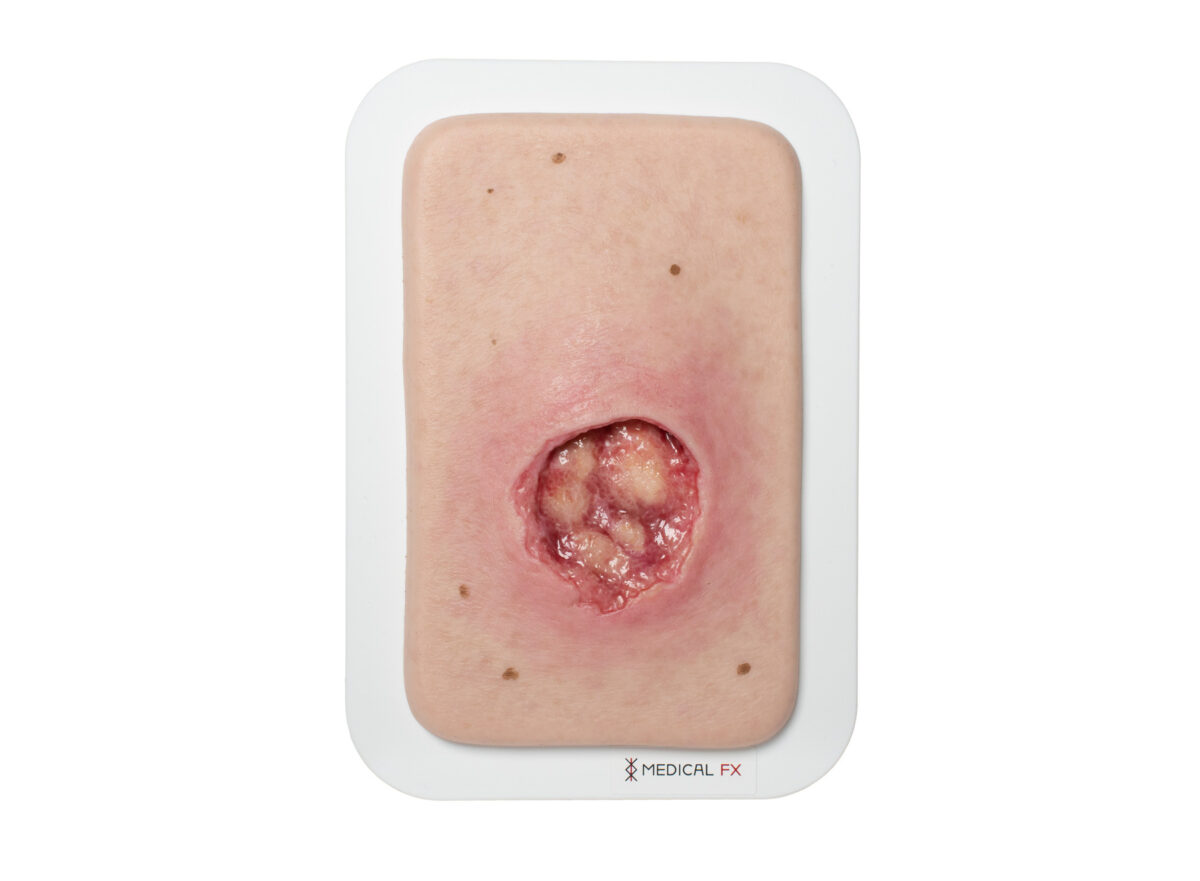 Pocketwound Undermining