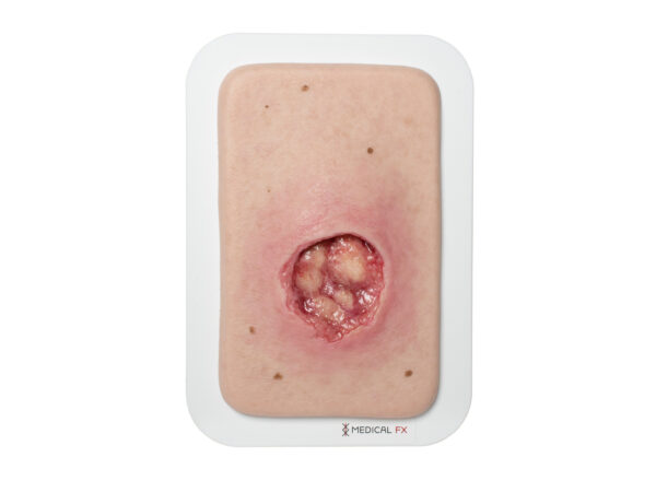 Pocketwound Undermining