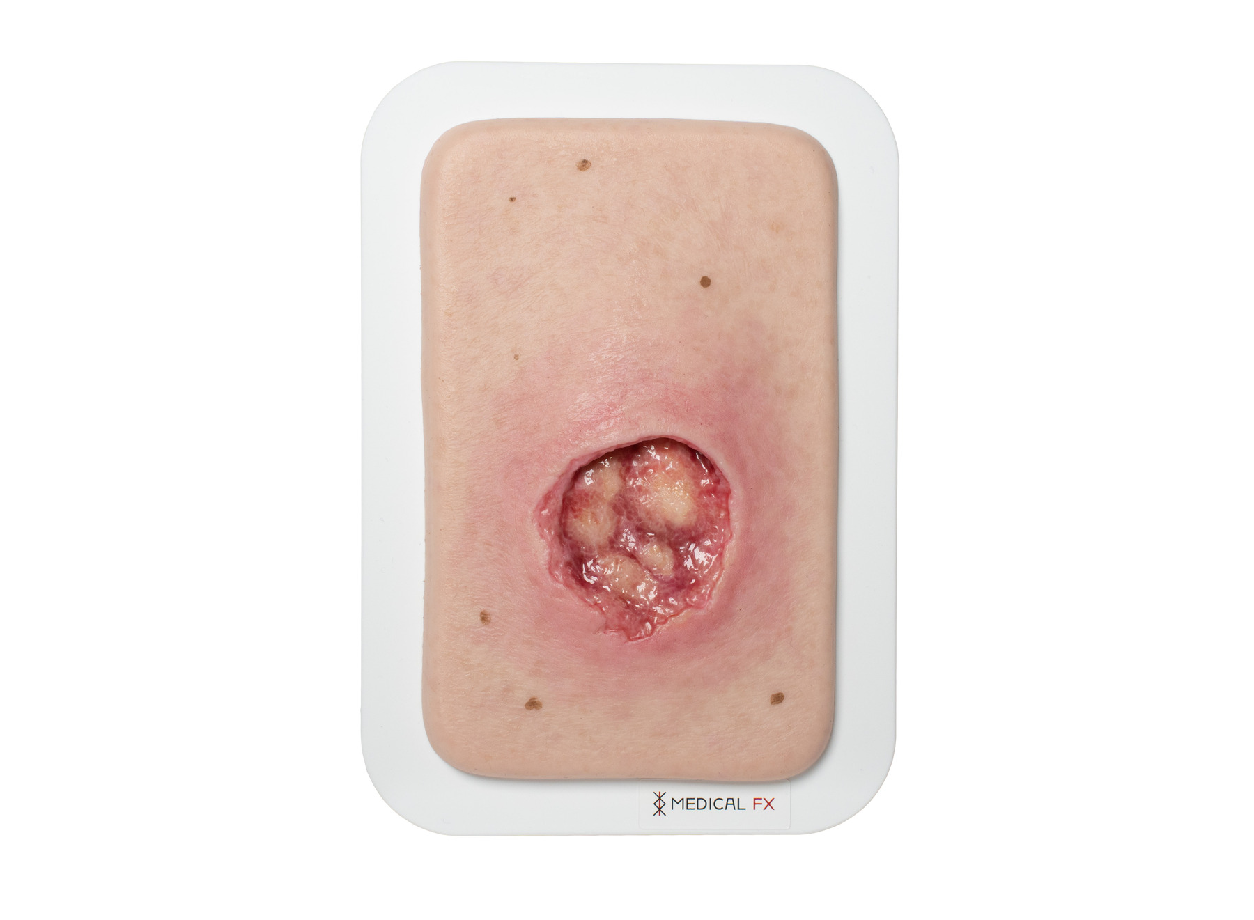 Pocketwound Undermining - Image 1