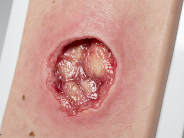 Pocketwound Undermining - Image 2