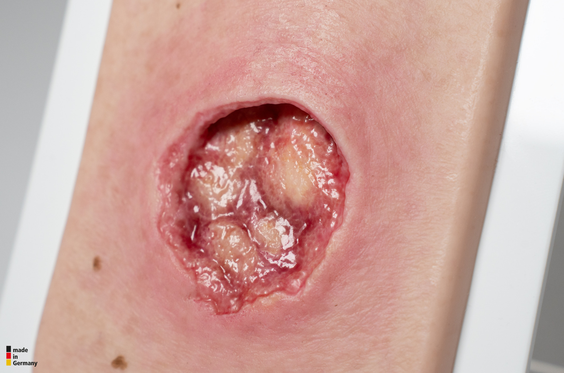 Pocketwound Undermining - Image 2