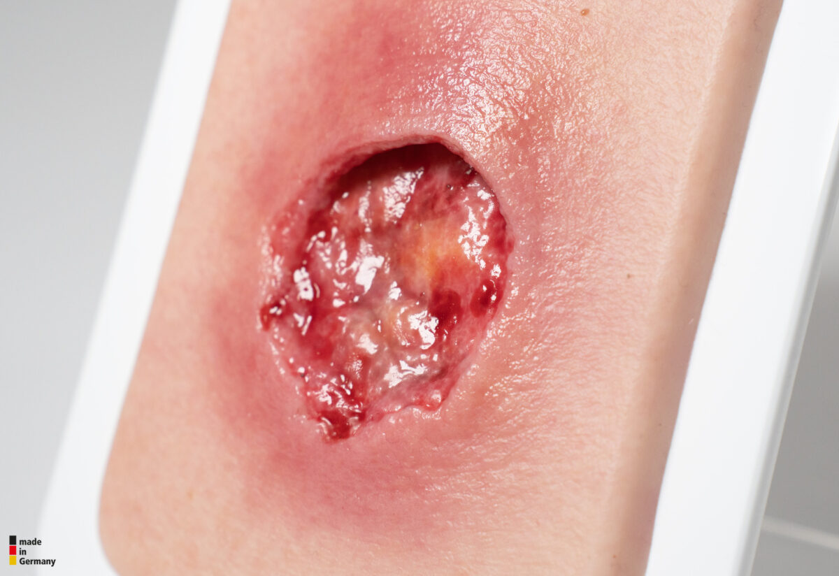 Pocketwound Undermining